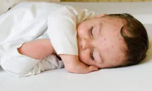 Kiedy wyjść z dzieckiem po ospie? Kluczowe informacje dla rodziców