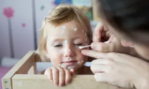 Mała dziewczynka z ospą na twarzy, której mama smaruje zmiany. Czekamy, aż znikną wszystkie krostki, by móc wrócić do przedszkola.