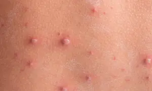 Skóra dziecka z licznymi pęcherzykami i krostkami, charakterystycznymi dla ospy. Wskazówki, jak kąpać dziecko z ospą, pomogą złagodzić swędzenie.