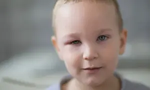 Co na opuchnięte oko u dziecka? Skuteczne sposoby i porady