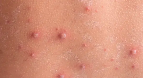 Skóra dziecka z licznymi pęcherzykami i krostkami, charakterystycznymi dla ospy. Wskazówki, jak kąpać dziecko z ospą, pomogą złagodzić swędzenie.