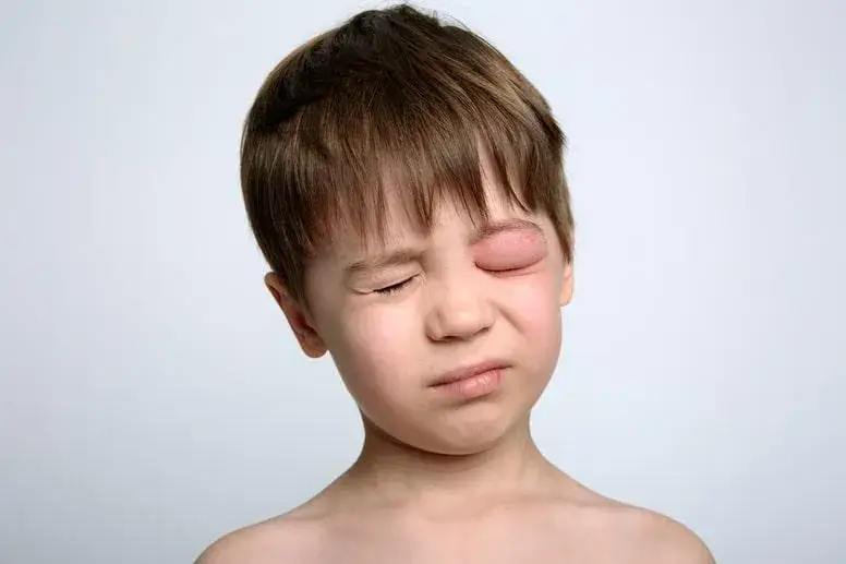 Zdjęcie Co na opuchnięte oko u dziecka? Skuteczne sposoby i porady