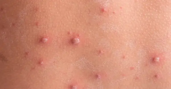 Skóra dziecka z licznymi pęcherzykami i krostkami, charakterystycznymi dla ospy. Wskazówki, jak kąpać dziecko z ospą, pomogą złagodzić swędzenie.